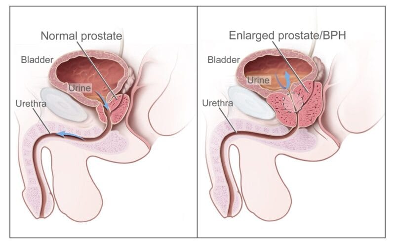 Diagrama medico de la prostata mostrando hiperplasia prostatica benigna (HPB)